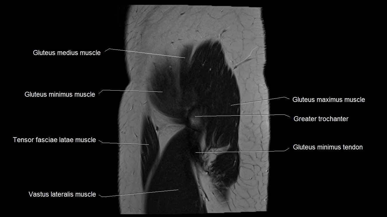 Hip sagittal cross sectional anatomy image 4.webp